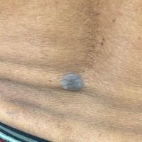 Seborrhoeic keratosis - skin of colourCopied with…