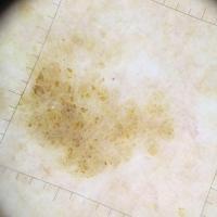Seborrhoeic keratosis - many comedo-like…