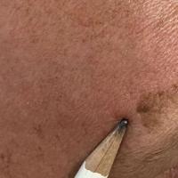 Seborrhoeic keratosis