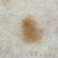 Seborrhoeic keratosisMultiple small, brown,…