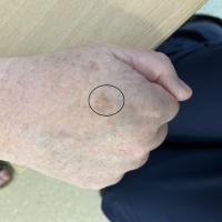 Seborrhoeic keratosis - thinCopied with kind…