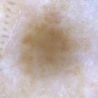 Dermoscopic image of previous figureMultiple…