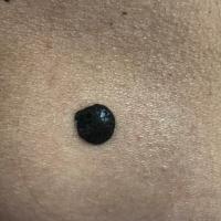 Seborrhoeic keratosis in skin of colour