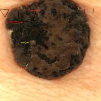 Dermoscopic appearance of previous figure
Red…