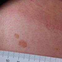 Seborrhoeic keratoses