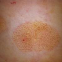 Dermoscopic appearance of previous figure