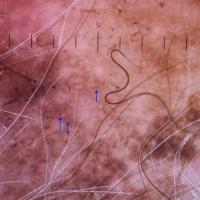 A thin seborrhoeic keratosis -&nbsp;top of…