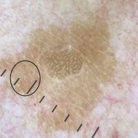 Dermoscopic appearance of previous figureThe…