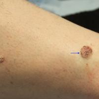A verrucous keratosisThe lesion on the left is a…