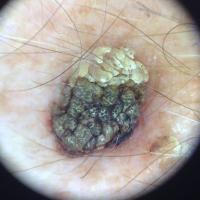 Dermoscopic image of a verrucous keratosisShowing…