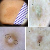 Circles in different lesionsAs with any skin…