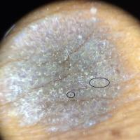 Dermoscopic appearance of previous figureFissures…