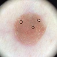 Dermoscopic appearance of previous figureA single…