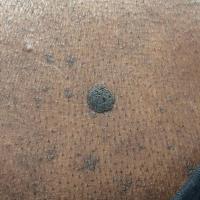 Seborrhoeic keratosis - skin of colourCopied with…