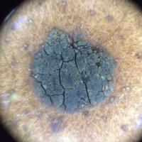 Dermoscopic appearance of previous figureFissures