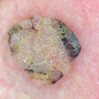 Dermoscopic appearance of previous figure -…