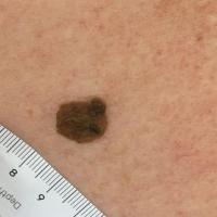 Seborrhoeic keratosis - a 'stuck-on'…