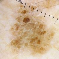 Seborrhoeic keratosisMultiple clues -…