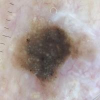 Dermoscopy to the rescue - same lesion as…