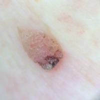 Dermoscopic appearance of previous figure