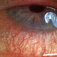
	Sj&ouml;gren's syndrome

	Dry mouth, dry…