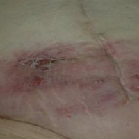 
	Metastatic spread from the bladder

	Copied…