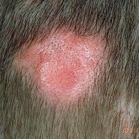 
	Alopecia neoplastica secondary to breast…