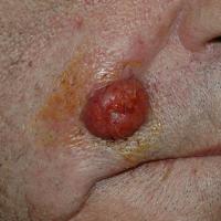 
	Metastatic lung cancer

	Copied with kind…