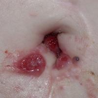 
	Sister Joseph's nodule

	Copied with kind…