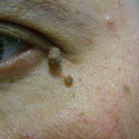 
	Skin tag close to eye