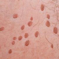 
	Multiple skin tags in the axilla
