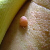 
	Larger skin tags are often reported…