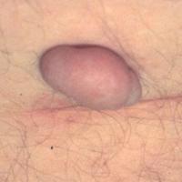 
	Large skin tag