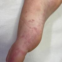 Angioma serpiginosum
Copied&nbsp;with…