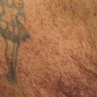 
	Generalised essential telangiectasia
	
	This…