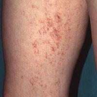 
	Angioma serpiginosum