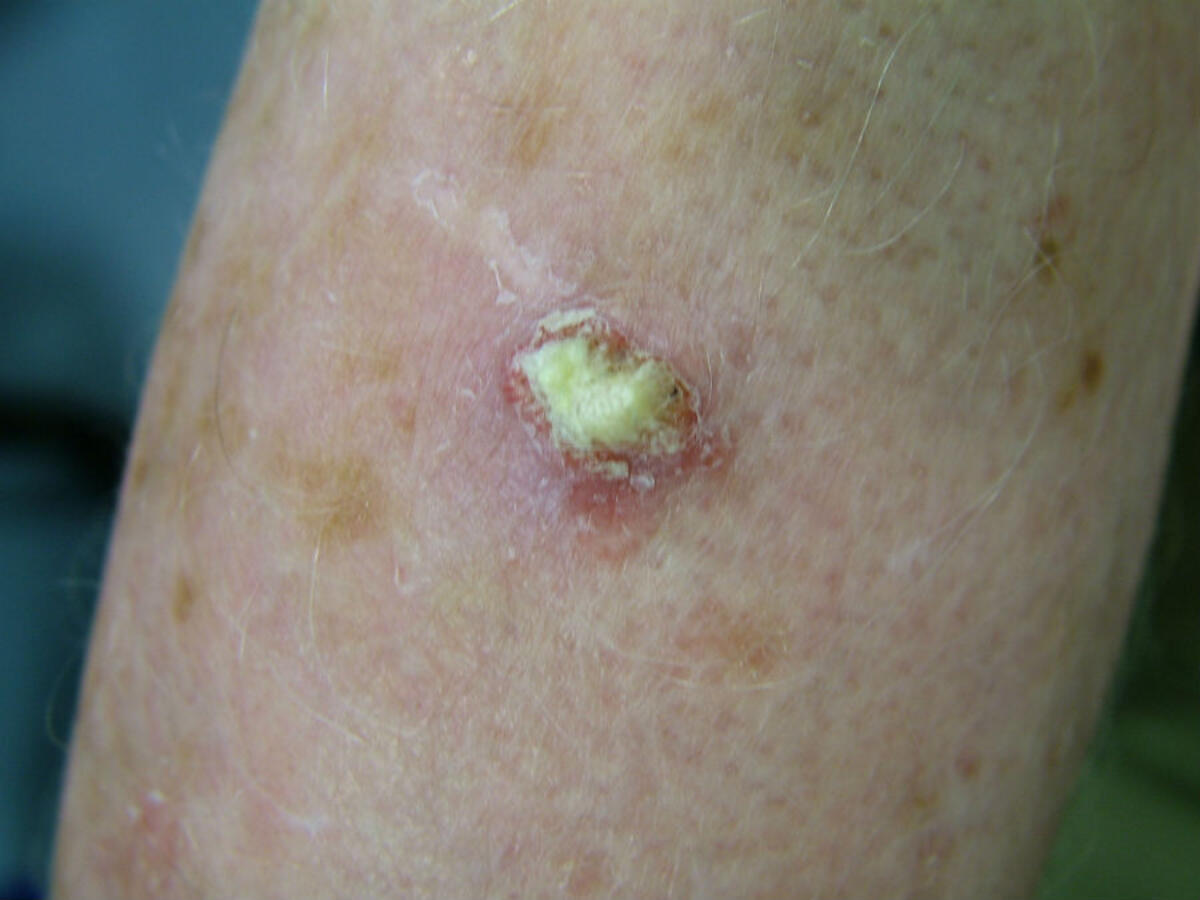 squamous-cell-carcinoma