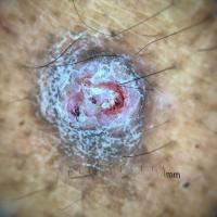 Dermoscopy of an SCC - skin of colourCopied with…