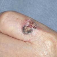 Poorly-differentiated SCCSome SCC are more subtle…