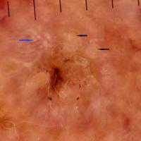 Dermoscopic appearance of previous…