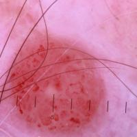 Dermoscopic appearance of previous figure&nbsp;A…