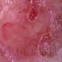 Dermoscopic appearance of previous figure&nbsp;A…