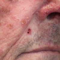 Poorly-differentiated SCCJust like a non-healing…