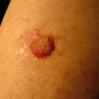 Poorly-differentiated SCCThe nodule was moist and…