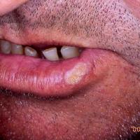 
	SCC of the lower lip
	
	Beware of any…