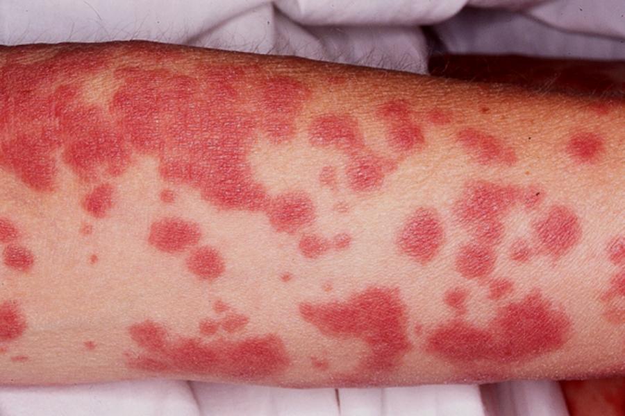 Stevens Johnson Syndrome