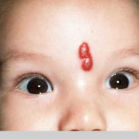 
	Infantile haemangioma