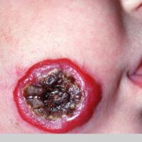
	Infantile haemangioma