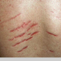 Stria Rash Striae - stretch marks