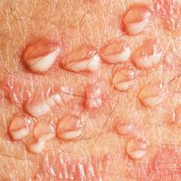 
	Subcorneal pustular dermatosis